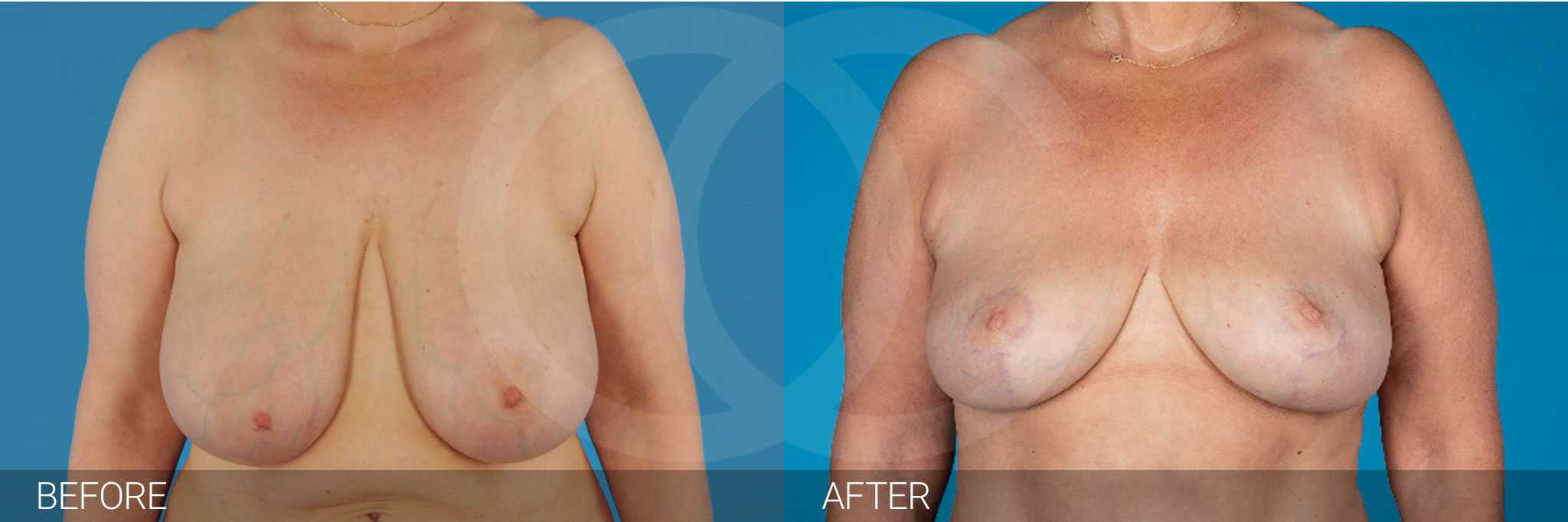 Breast Reduction Hall-Findlay ante/post-op I