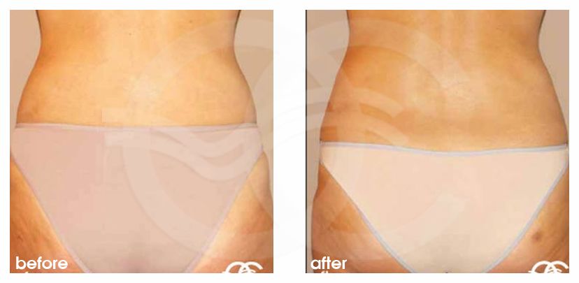 Brazilian Buttock Augmentation before and after real clinical case 03