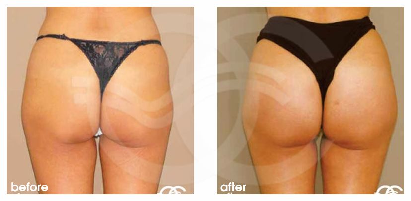 Brazilian Buttock Augmentation before and after real clinical case 02