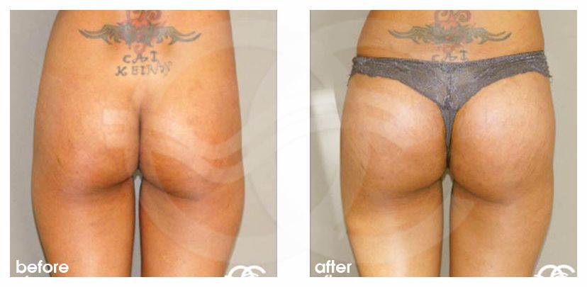 Brazilian Buttock Augmentation before and after real clinical case 01