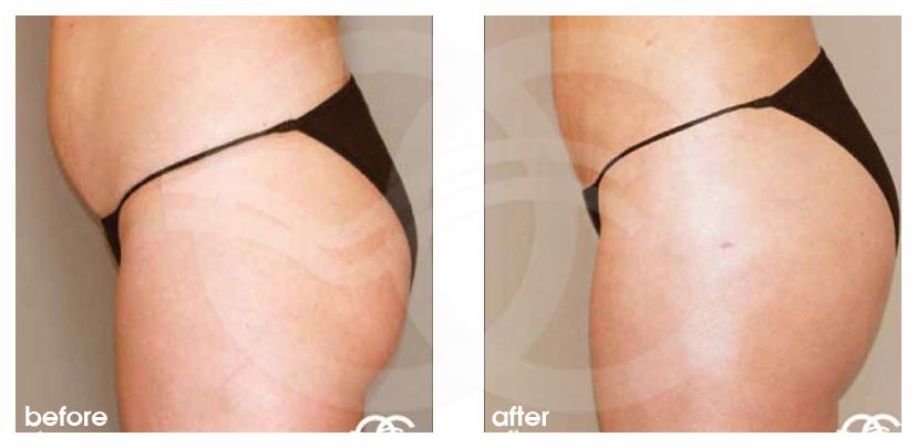 Gesäßvergrößerung 02 PO-STRAFFUNG MIT EIGENFETT BRAZILIAN BUTT LIFT before after forntal