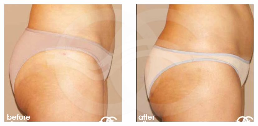 Augmentation des Fesses 03 ante/post-op lateral