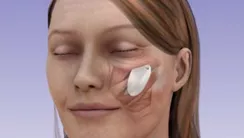 Implantes Faciales: Mejillas (malares), Mentón, Nasales