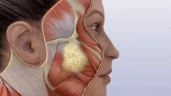 Lifting Facial - Parte Media y Parte Baja