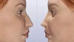Rinoplastia: Técnica Cerrada y Abierta