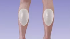 Implantes de : pantorrillas y pectorales
