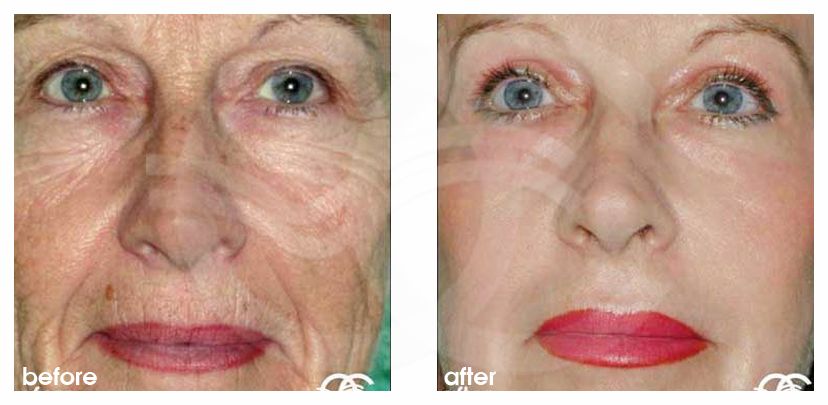 Peeling profundo ROSTRO COMPLETO ante/post-op profil