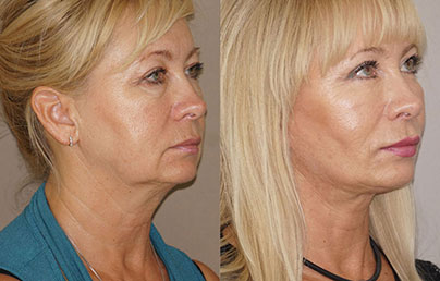 Recovery and Aftercare - Deep Plane Neck Lift | Ocean Clinic Marbella