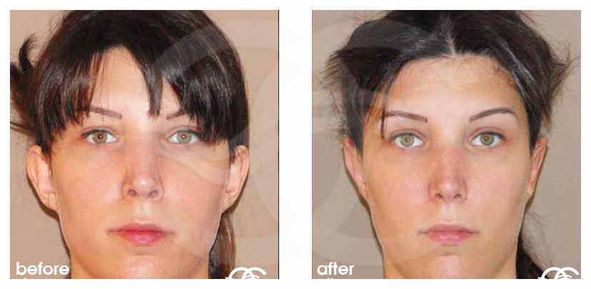 Otoplasty before and after real clinical case 03