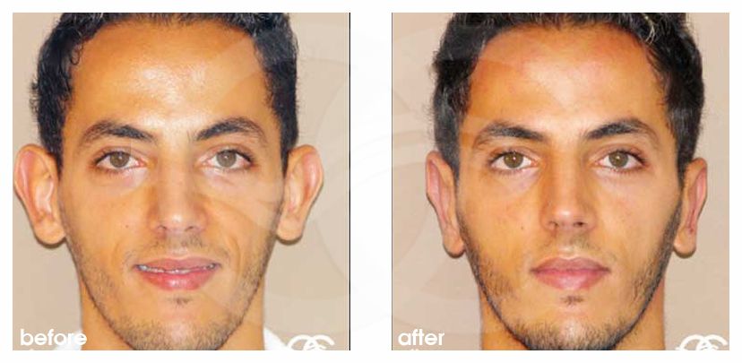 Otoplasty before and after real clinical case 02