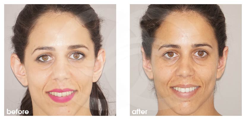 Otoplasty before and after real clinical case 01