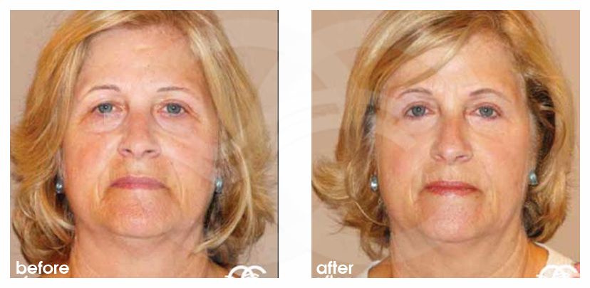 Eyelid Surgery Blepharoplasty - before and after real clinical case 03