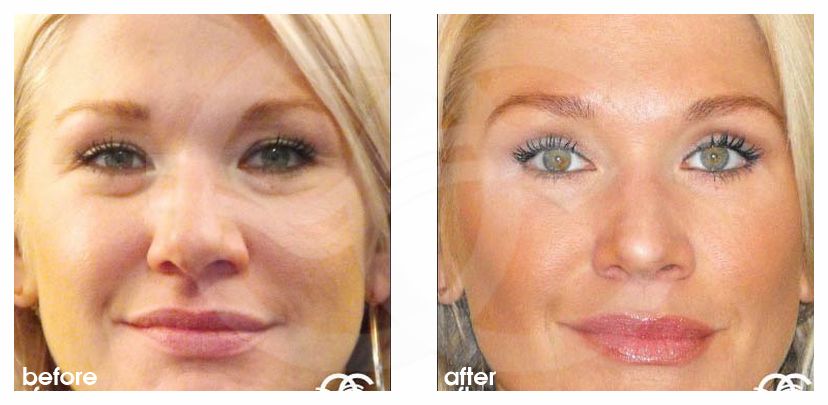 Eyelid Surgery Blepharoplasty - before and after real clinical case 02