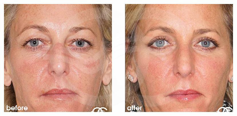 Eyelid Surgery Blepharoplasty - before and after real clinical case 01