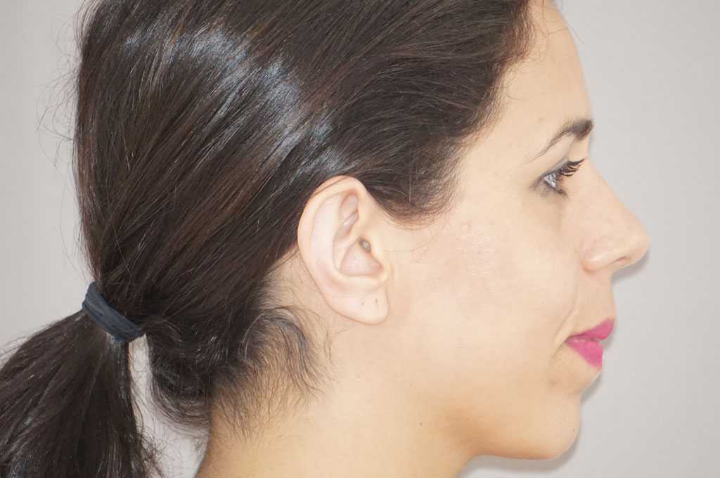 Cirugía de las orejas Otoplastia Antihélix ante-op lateral
