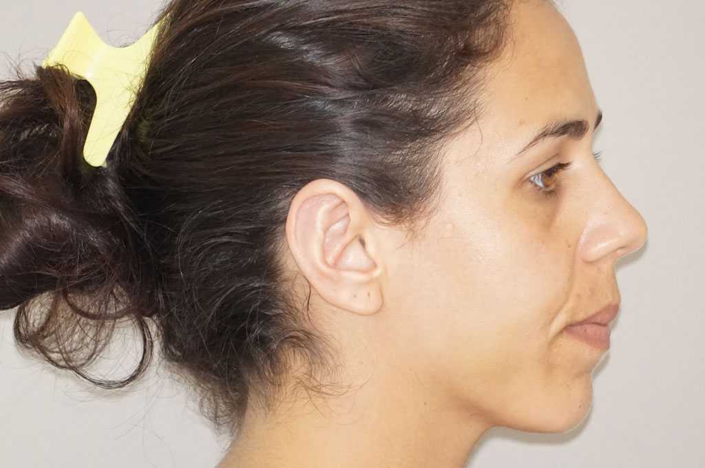 Cirugía de las orejas Otoplastia Antihélix post-op lateral