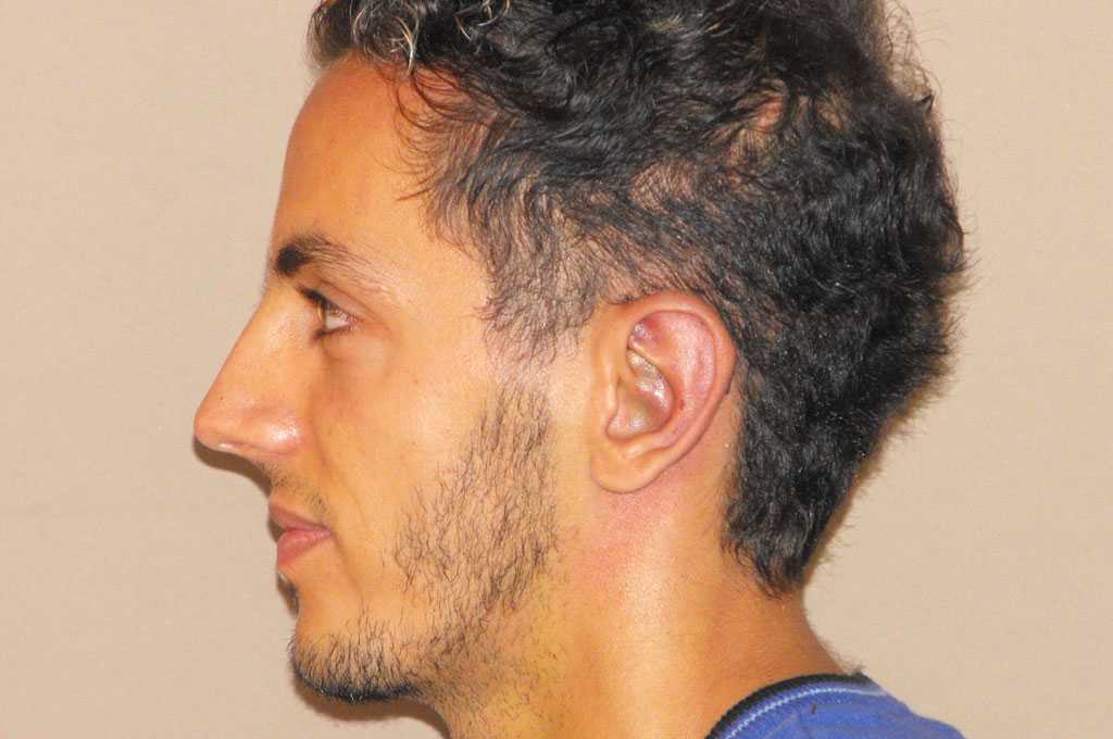 Cirugía de las orejas Otoplastia Cartílago Conchal post-op retro/lateral