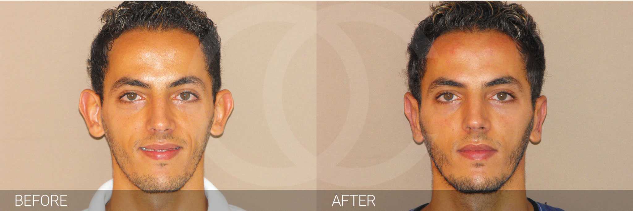 Concha Reduction and Antihelixplasty Ear Correction Before after