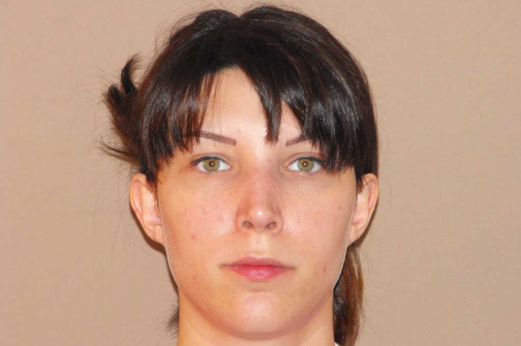 Photos Ear Correction  ante/post-op I