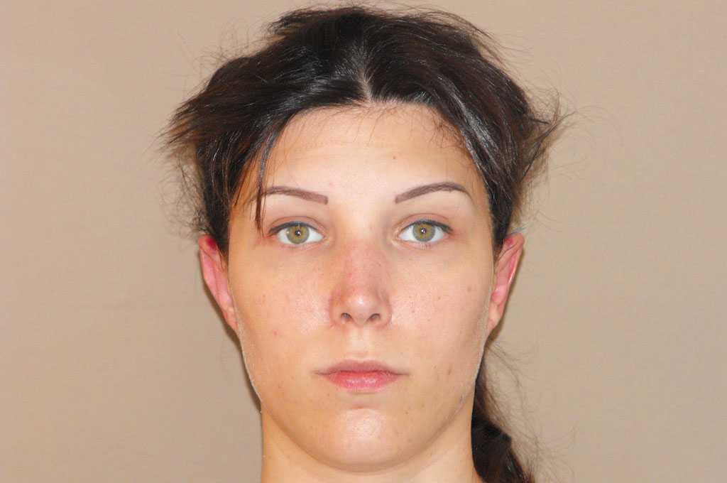 Photos Ear Correction  ante/post-op I