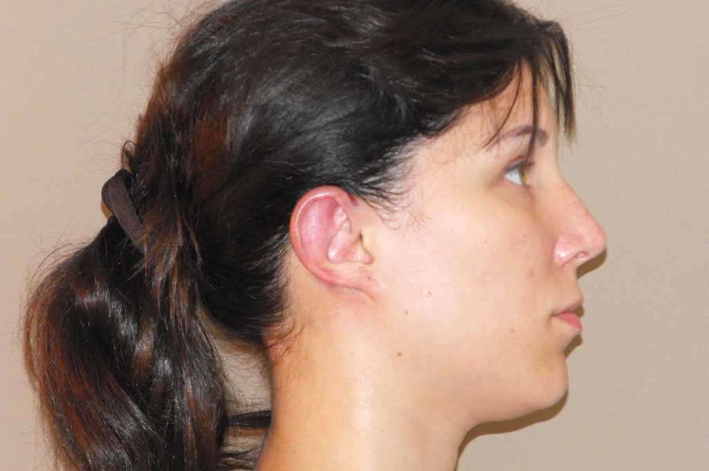 Ear Correction Otoplasty ante/post-op II