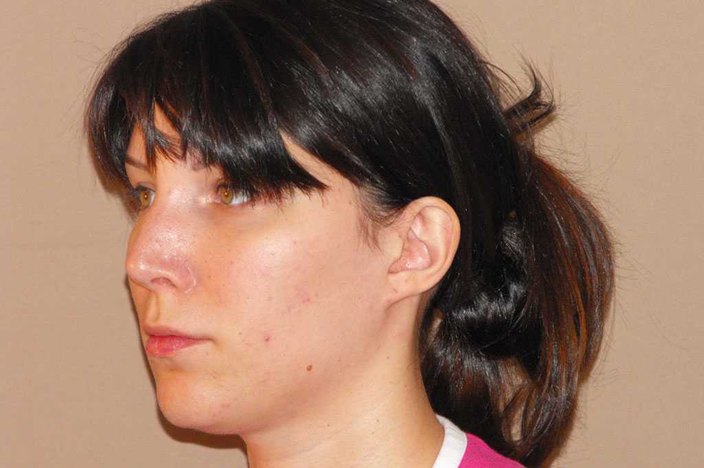 Photos Ear Correction  ante/post-op III