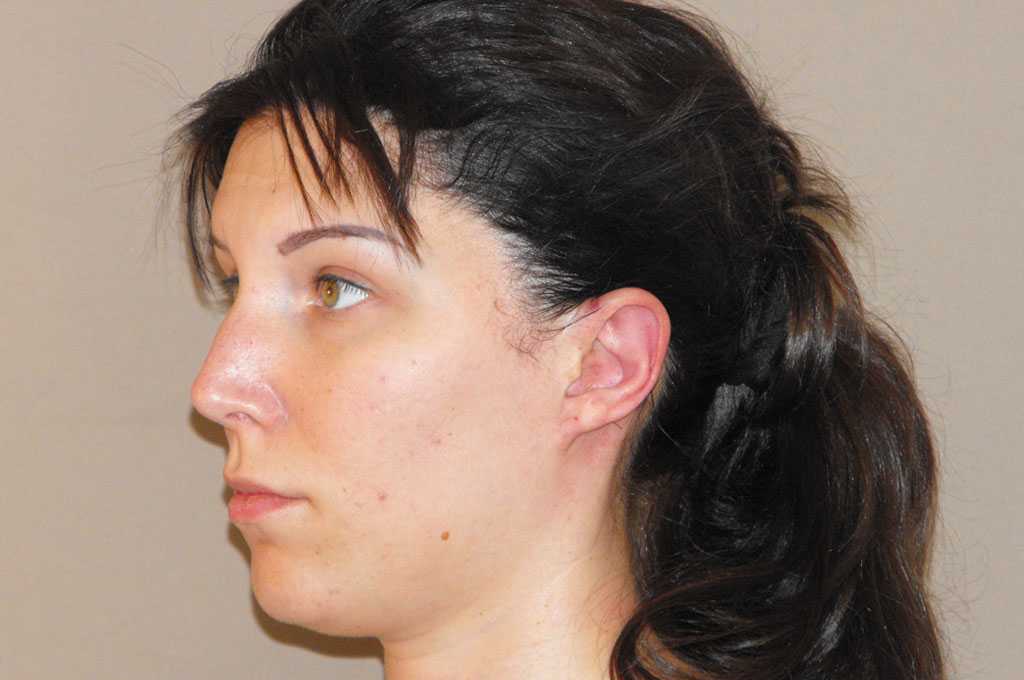 Photos Ear Correction  ante/post-op III