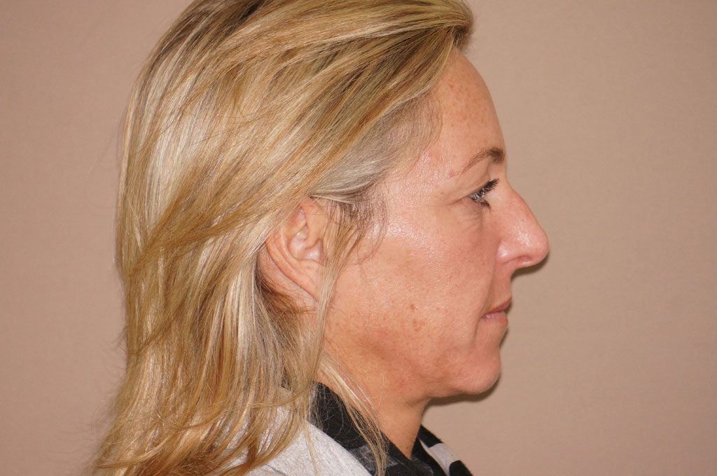 Eyelid Lift UPPER AND LOWER TOGETHER ante-op lateral