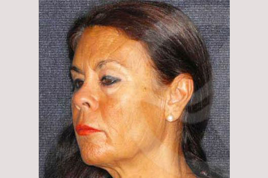 Face and Neck Lift MACS lift ante/post-op II