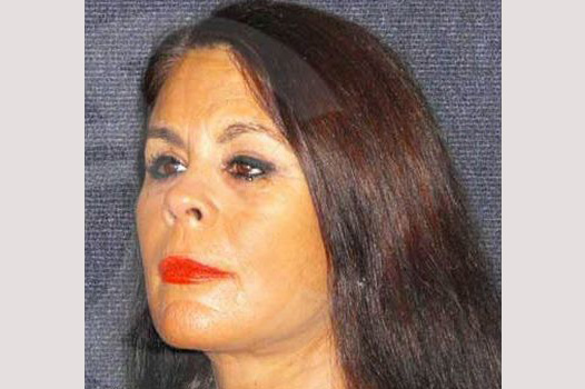 Fotos Lifting de cara y cuello  ante/post-op II