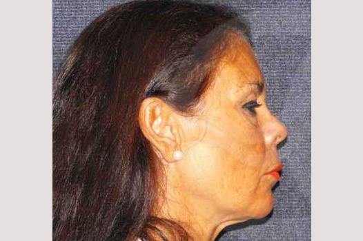 Face and Neck Lift MACS lift ante/post-op III