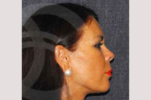 Face and Neck Lift MACS lift ante/post-op III