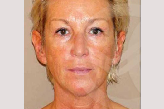 Fotos Lifting de cara y cuello  ante/post-op I