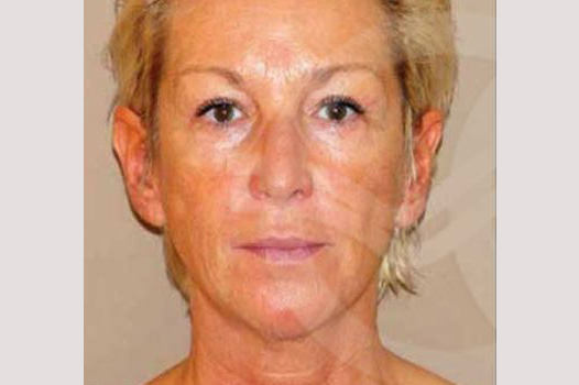 Face and Neck Lift PAVE-lift ante/post-op I