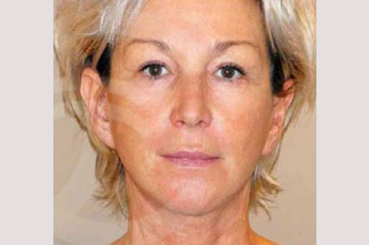 Face and Neck Lift PAVE-lift ante/post-op I