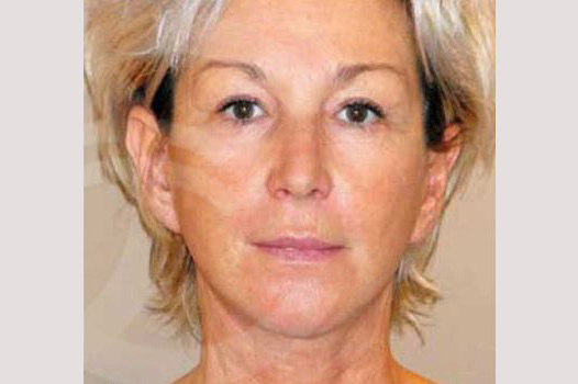 Fotos Lifting de cara y cuello  ante/post-op I