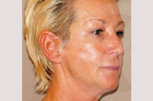 Face and Neck Lift PAVE-lift ante/post-op II