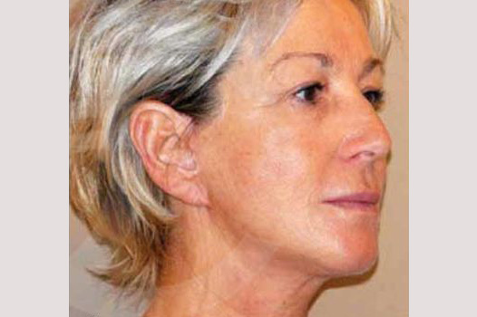 Face and Neck Lift PAVE-lift ante/post-op II