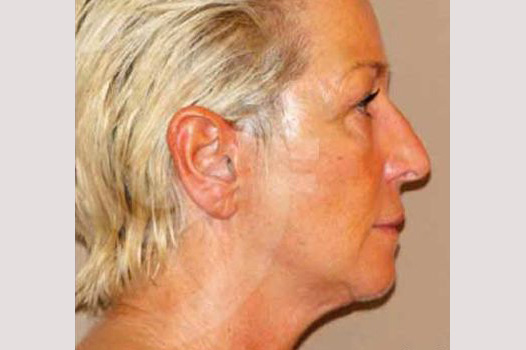 Face and Neck Lift PAVE-lift ante/post-op III