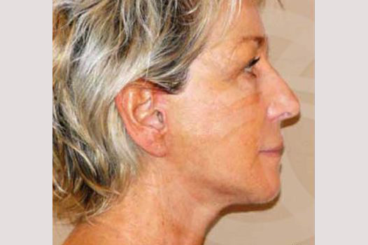 Face and Neck Lift PAVE-lift ante/post-op III