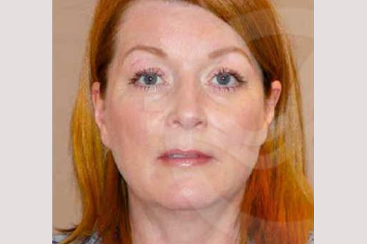 Fotos Lifting de cara y cuello  ante/post-op I