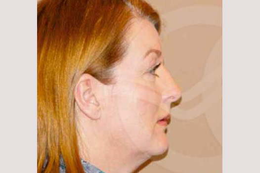 Lifting de cara y cuello MACS transferencia de grasa ante/post-op III