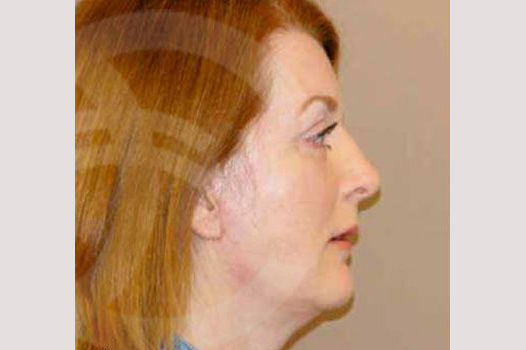 Face and Neck Lift MACS with fat grafting ante/post-op III