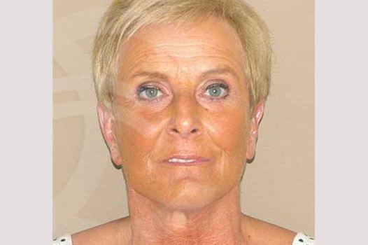 Fotos Lifting de cara y cuello  ante/post-op I