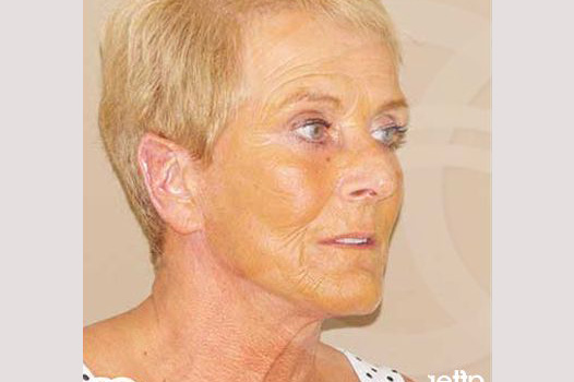 Fotos Lifting de cara y cuello  ante/post-op II