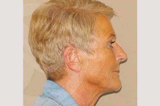 Fotos Lifting de cara y cuello  ante/post-op III