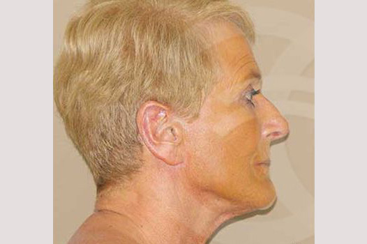 Lifting de cara y cuello PAVE cara y cuello ante/post-op III