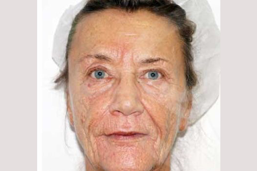 Face and Neck Lift PAVE-Facelift ante/post-op I