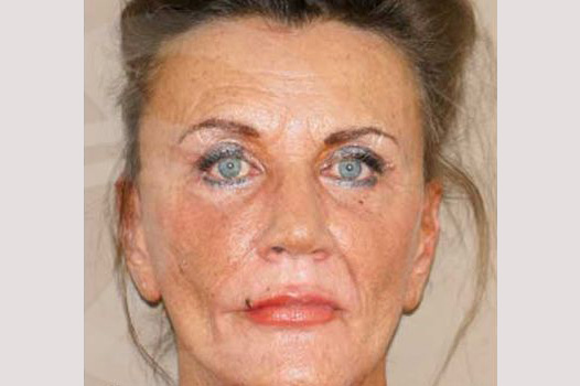 Fotos Lifting de cara y cuello  ante/post-op I