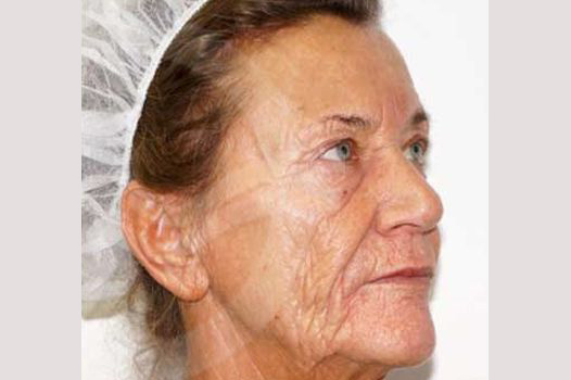 Face and Neck Lift PAVE-Facelift ante/post-op II